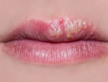 Έρπης: Γιατί είναι συχνότερος το καλοκαίρι – Τι συμβαίνει με την ακτινοβολία του ήλιου (βίντεο)